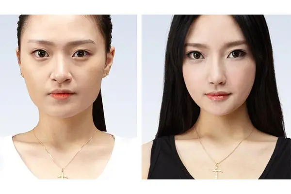 Elevating the cheekbones helps improve cheek contours to be plump, youthful, and harmonious with the face