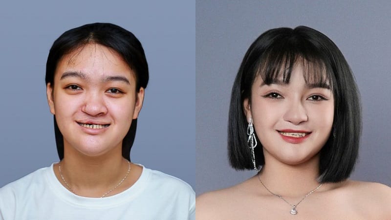 Post-operative image of Nhu Canh