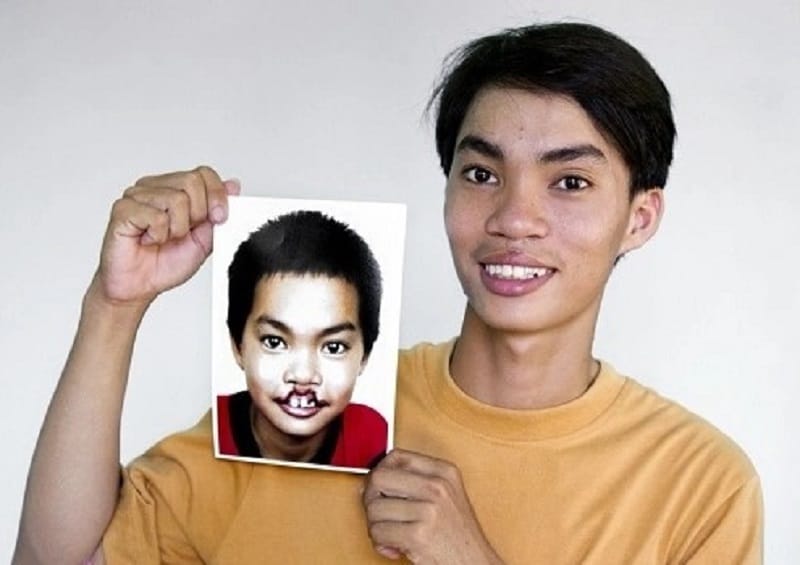 Post-operative cleft palate surgery image of a teenager