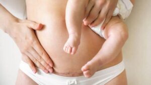 How Long After a C-Section Can You Get Liposuction?