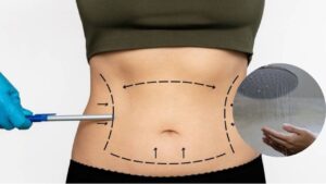 How Long After Liposuction Can You Shower?