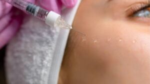 How Long Does Mesotherapy Last?