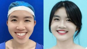 How Much Does Facial Asymmetry Surgery Cost?