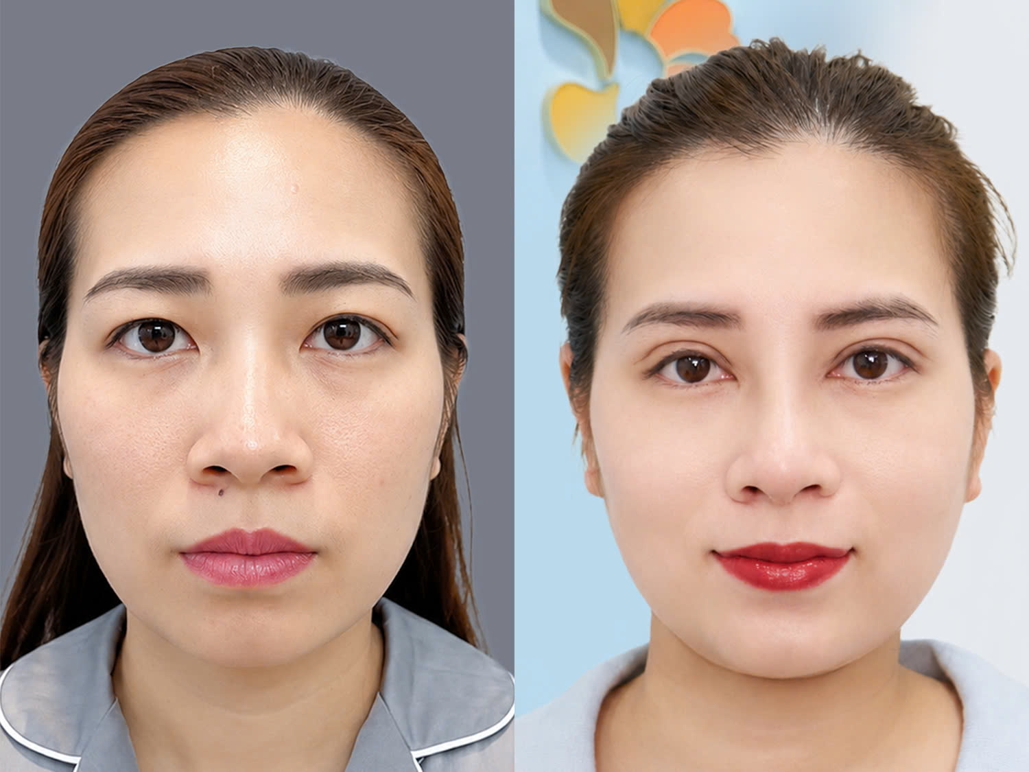 A patient with a dorsal hump achieved a more refined and natural-looking nose after rhinoplasty at Kangnam.
