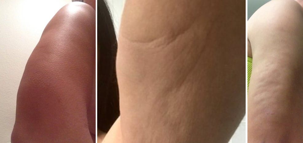 Arm liposuction may create slimmer contours and make patients feel more comfortable wearing different styles of clothing.
