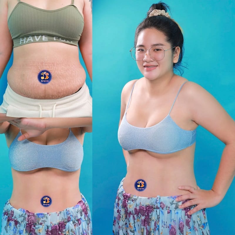 The treated abdominal area should be cared for according to the surgeon’s instructions.
