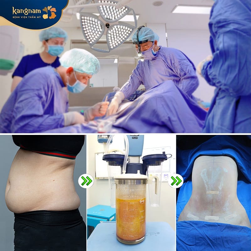 Kangnam performs liposuction through a medically structured treatment process.