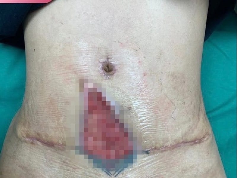 Showering too early after liposuction can cause infection and slow down the recovery process