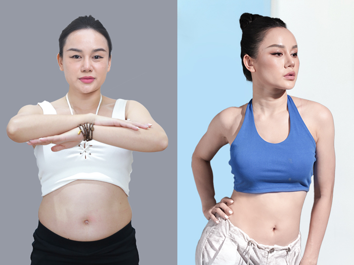 Improved body contours for a patient following pregnancy.