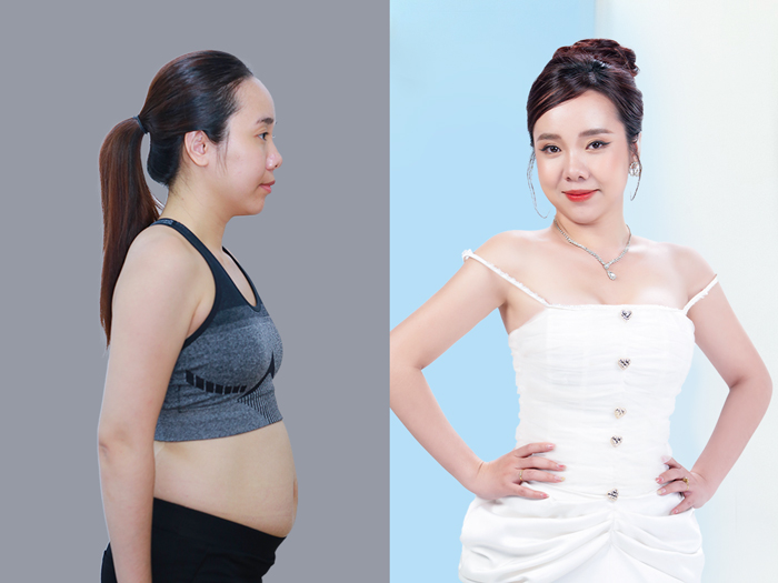 Suitable patients may notice improved abdominal contours following an appropriate treatment plan.
