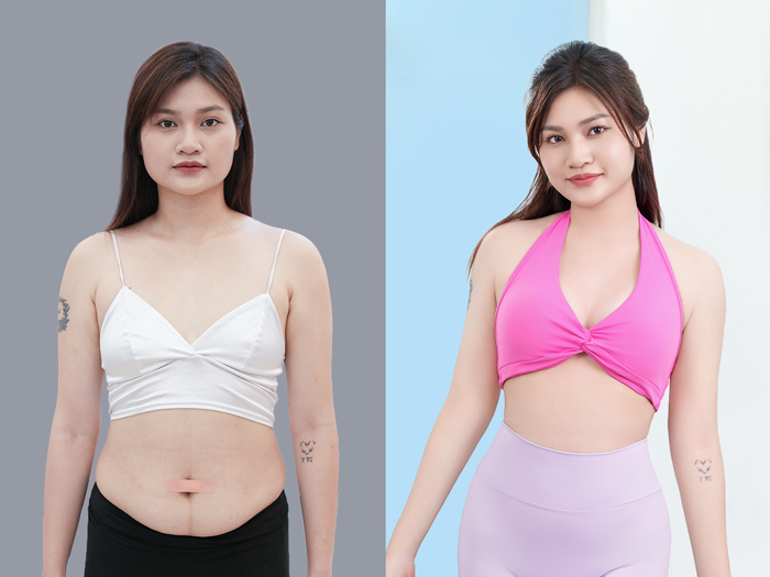 Modern liposuction technology may help reduce unnecessary tissue trauma and postoperative discomfort.