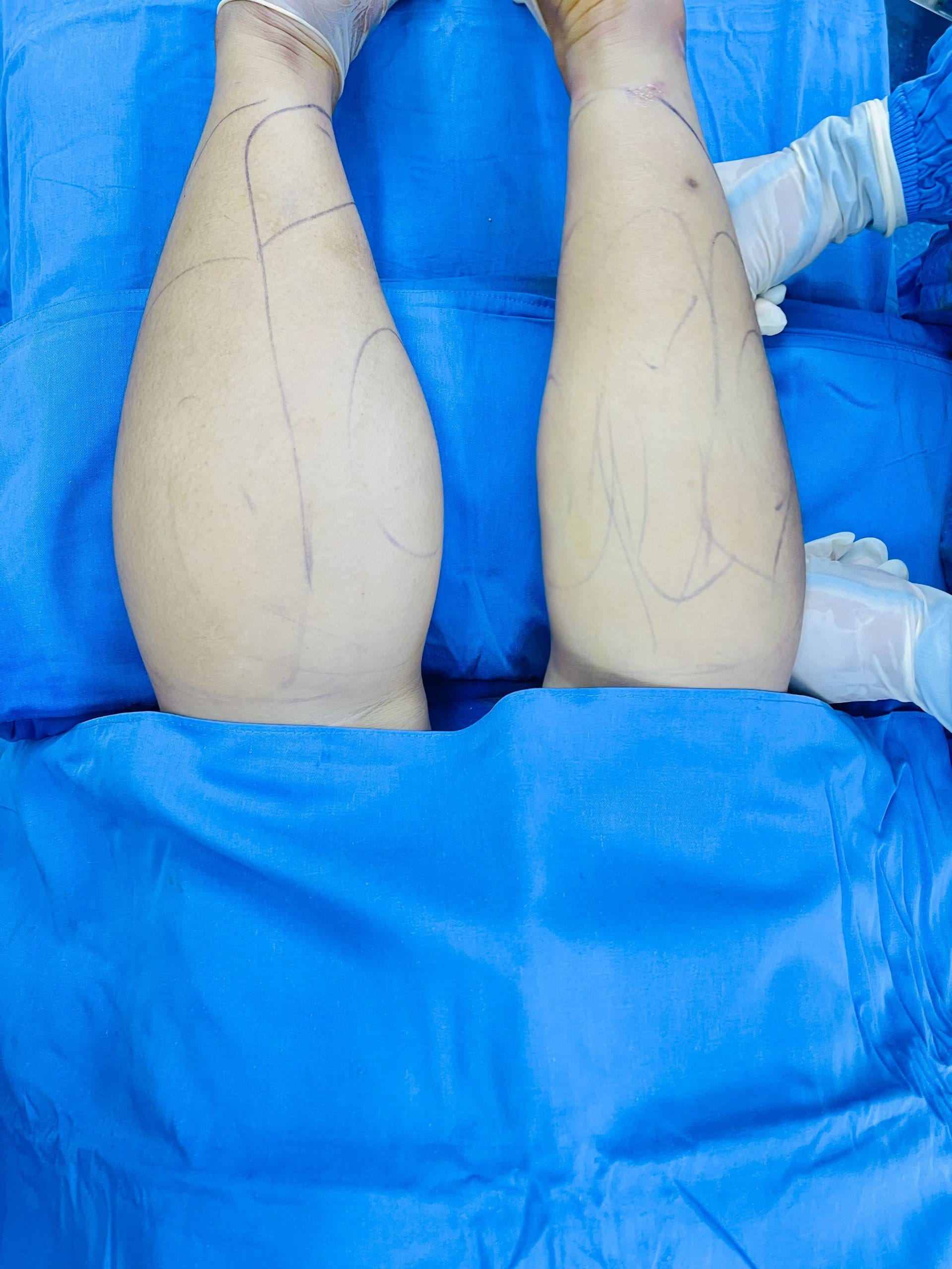 Leg liposuction removes localised excess fat to improve the shape of the legs.
