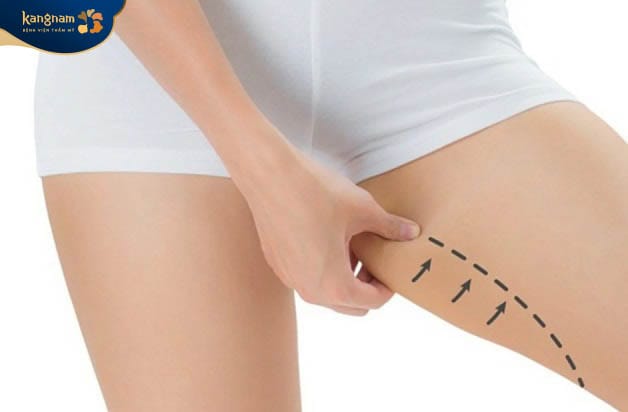 Thigh liposuction removes localised fat to create slimmer and more proportionate leg contours.