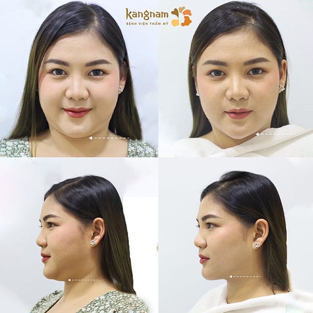 The lower face may appear lighter and more defined after suitable fat-reduction treatment.