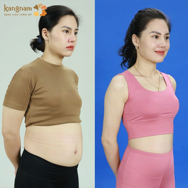 The full-body liposuction method helps remove accumulated excess body fat