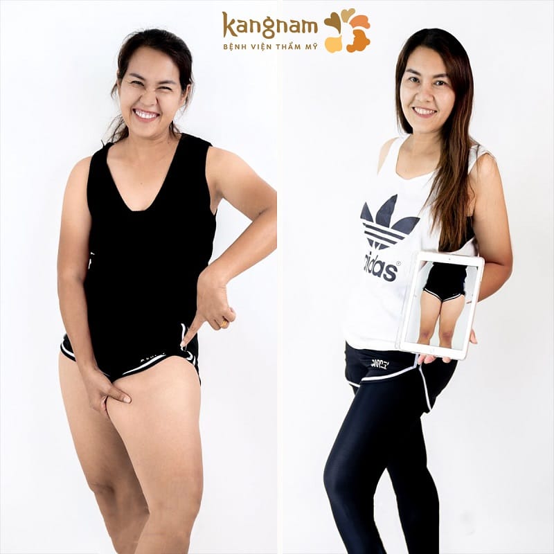 Liposuction helps reshape the body figure and supports health improvement