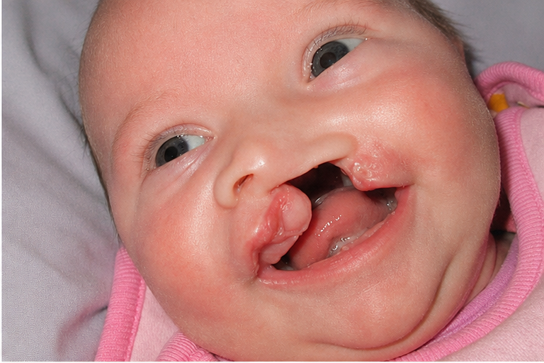 Children with a cleft palate usually cannot breastfeed directly or use standard baby bottles