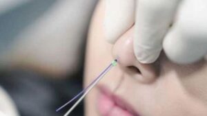Is Thread Lift Rhinoplasty Safe? Risks of Thread Exposure