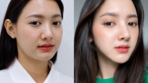Is Cheekbone Reduction Permanent?