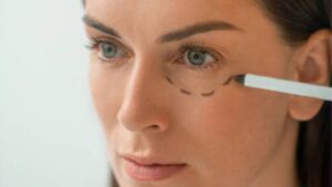 Is Eyelid Surgery Permanent? How Long Results Last