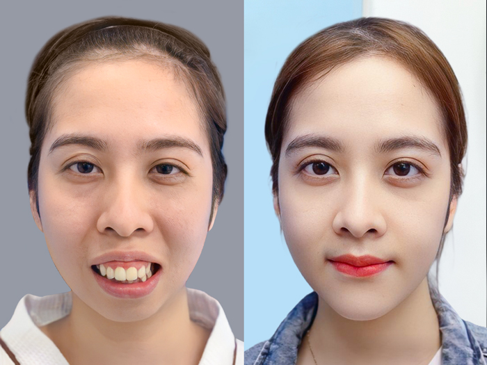 Improving facial asymmetry