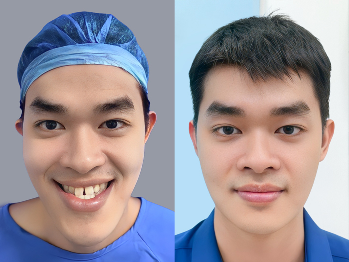 A client from Taiwan with a perfect facial result following overbite correction