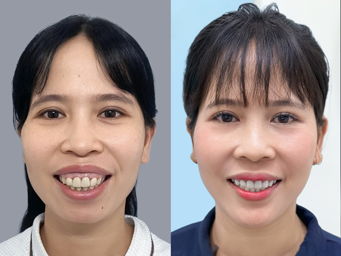 Balanced and natural facial contours after overbite jaw surgery