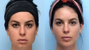 Jaw Slimming with Botox (Masseter Botox)