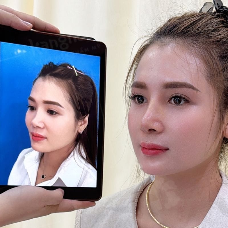 Overseas Vietnamese patients recover quickly after rhinoplasty.