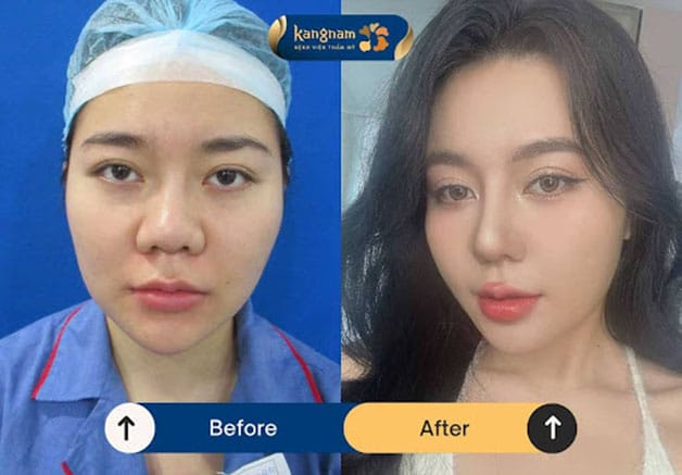 A refined nose that appears balanced with the proportions of the face.