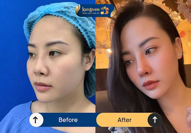 A more defined and sophisticated facial appearance after rhinoplasty at Kangnam.