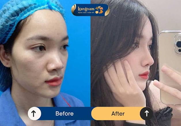 Greater confidence when showing the side profile after rhinoplasty at Kangnam.