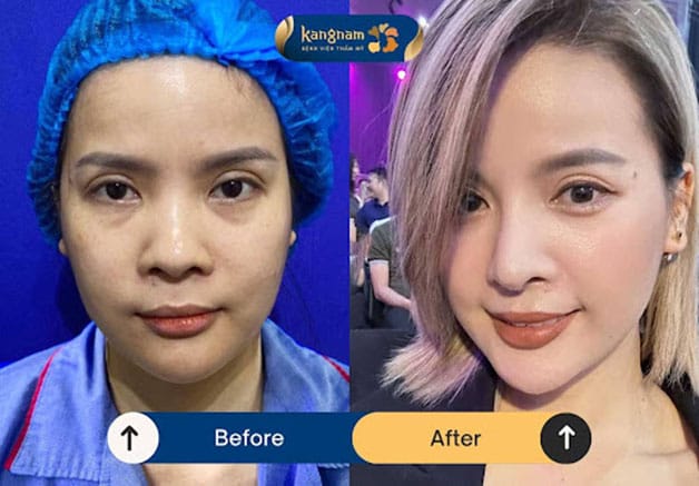 A higher, narrower, and straighter nose may create a more distinctive facial appearance.