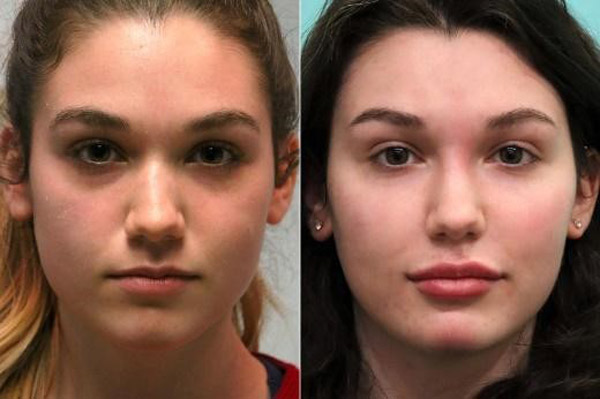 Temple augmentation using silicone implants is a modern cosmetic method