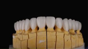 Lava Porcelain Crowns: Strength and Natural Beauty