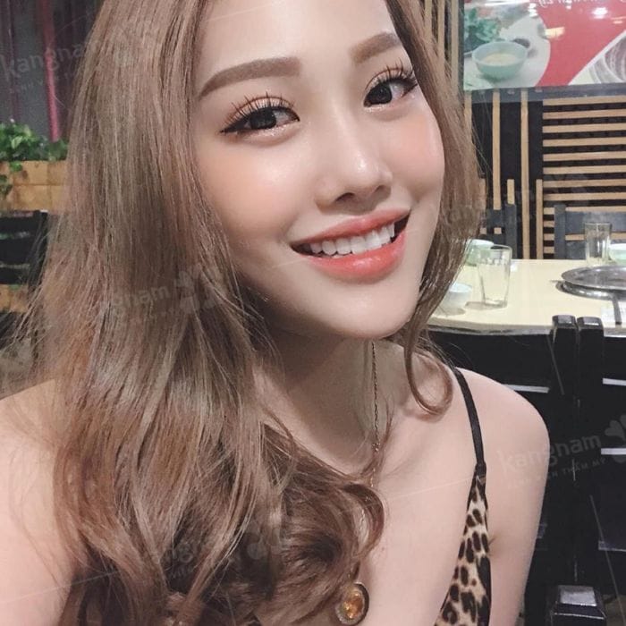 Results 1 month after eyelid fat removal at Kangnam