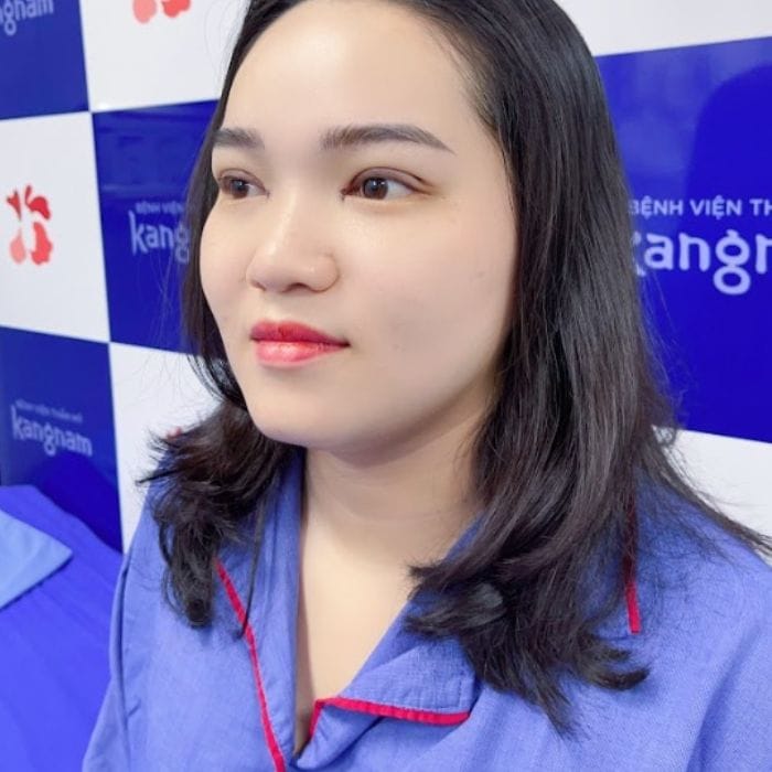 Larger, rounder, and more balanced eyes after eyelid fat removal