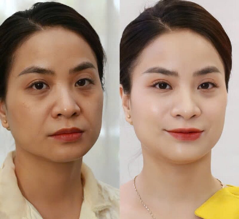 Khách hàng nên thực hiện trẻ hóa da tại cơ sở thẩm mỹ uy tín