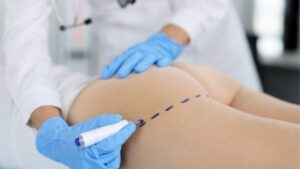 Is Liposuction with Fat Transfer to the Buttocks Safe?