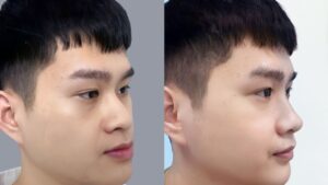 Long Face Surgery: Shortening an Elongated Face