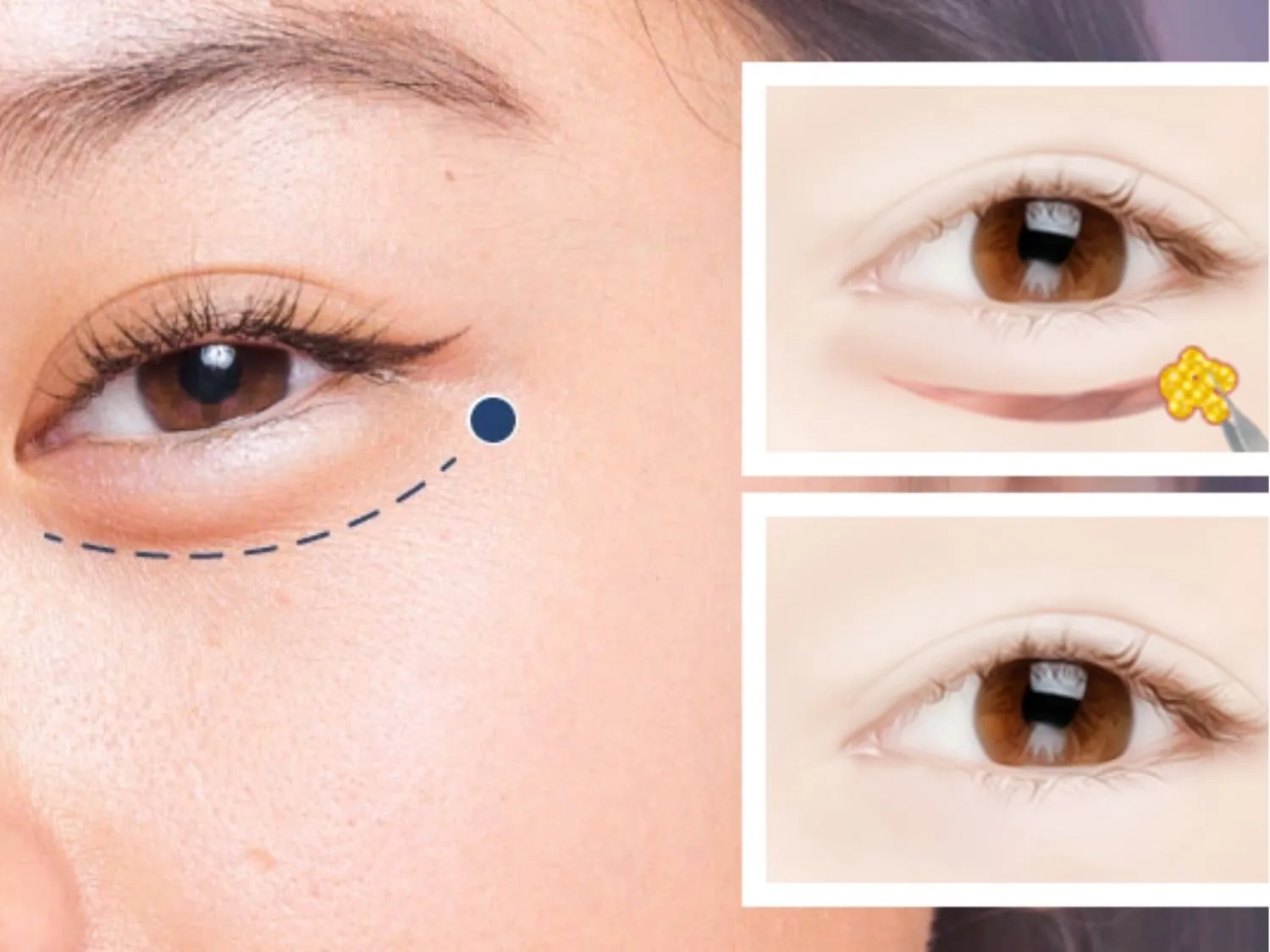 Lower eyelid blepharoplasty is a method to remove excess fat in the lower eyelid area