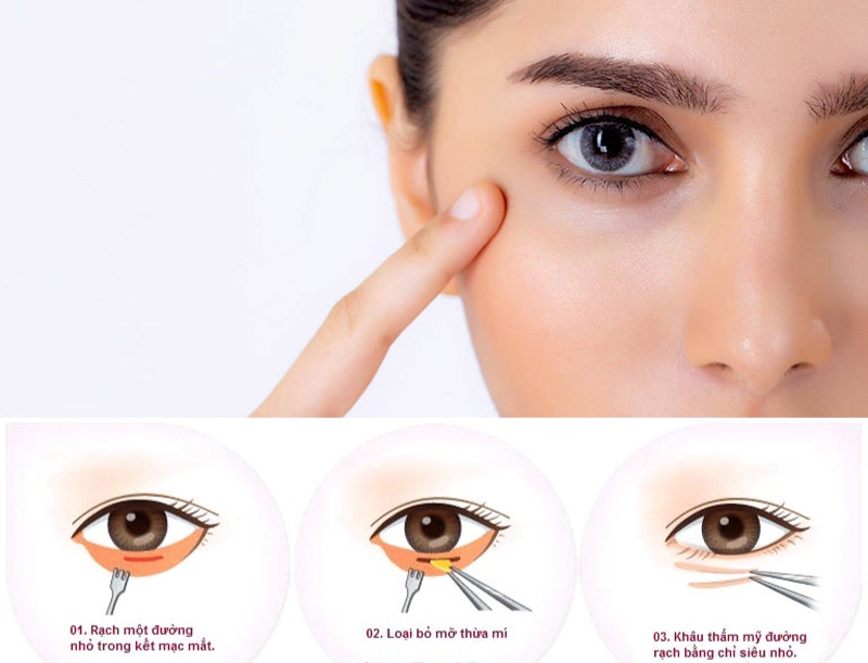 Lower eyelid blepharoplasty is a method to remove excess fat in the lower eyelid area