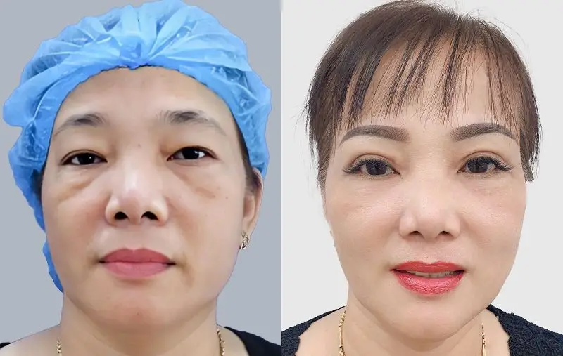 Eliminating lower eye bags and refining a natural eyelid line