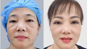 Lower Eyelid Rejuvenation for a Natural, Youthful Eye Area