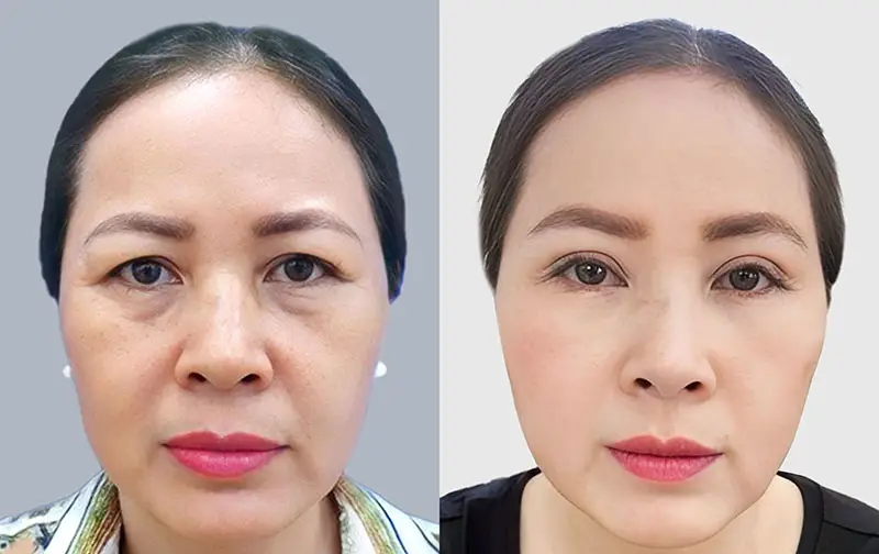 Eye rejuvenation after lower eye bag removal