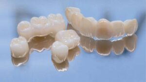 Metal Porcelain Crowns: An Affordable Option