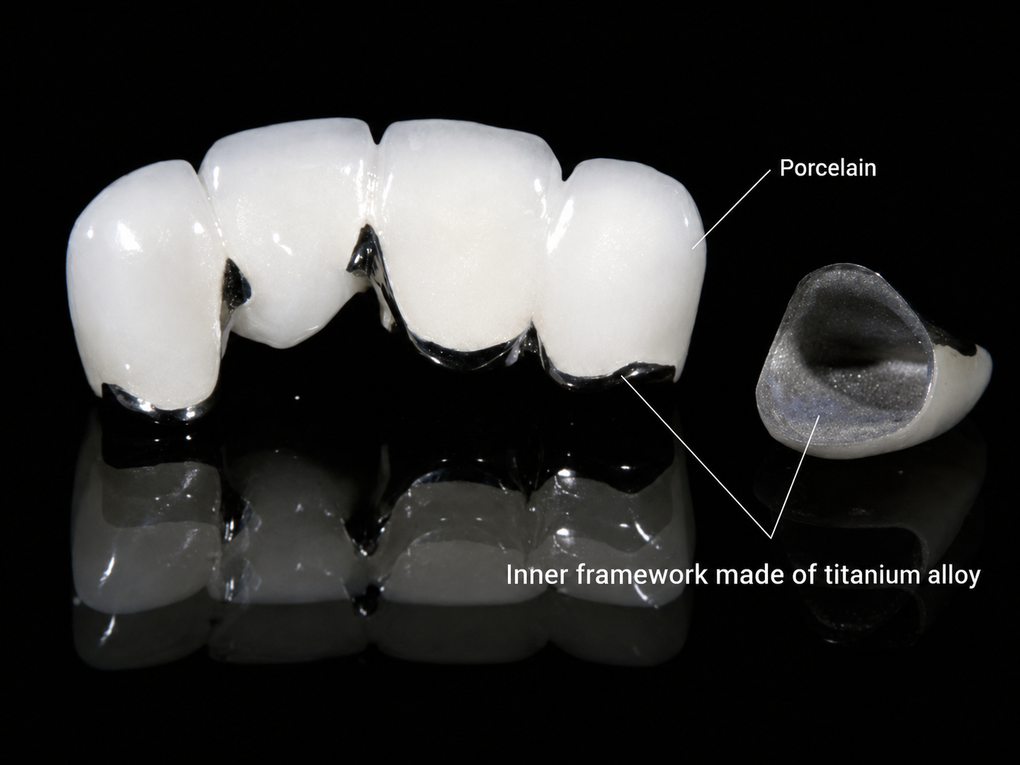 Titan porcelain crowns.