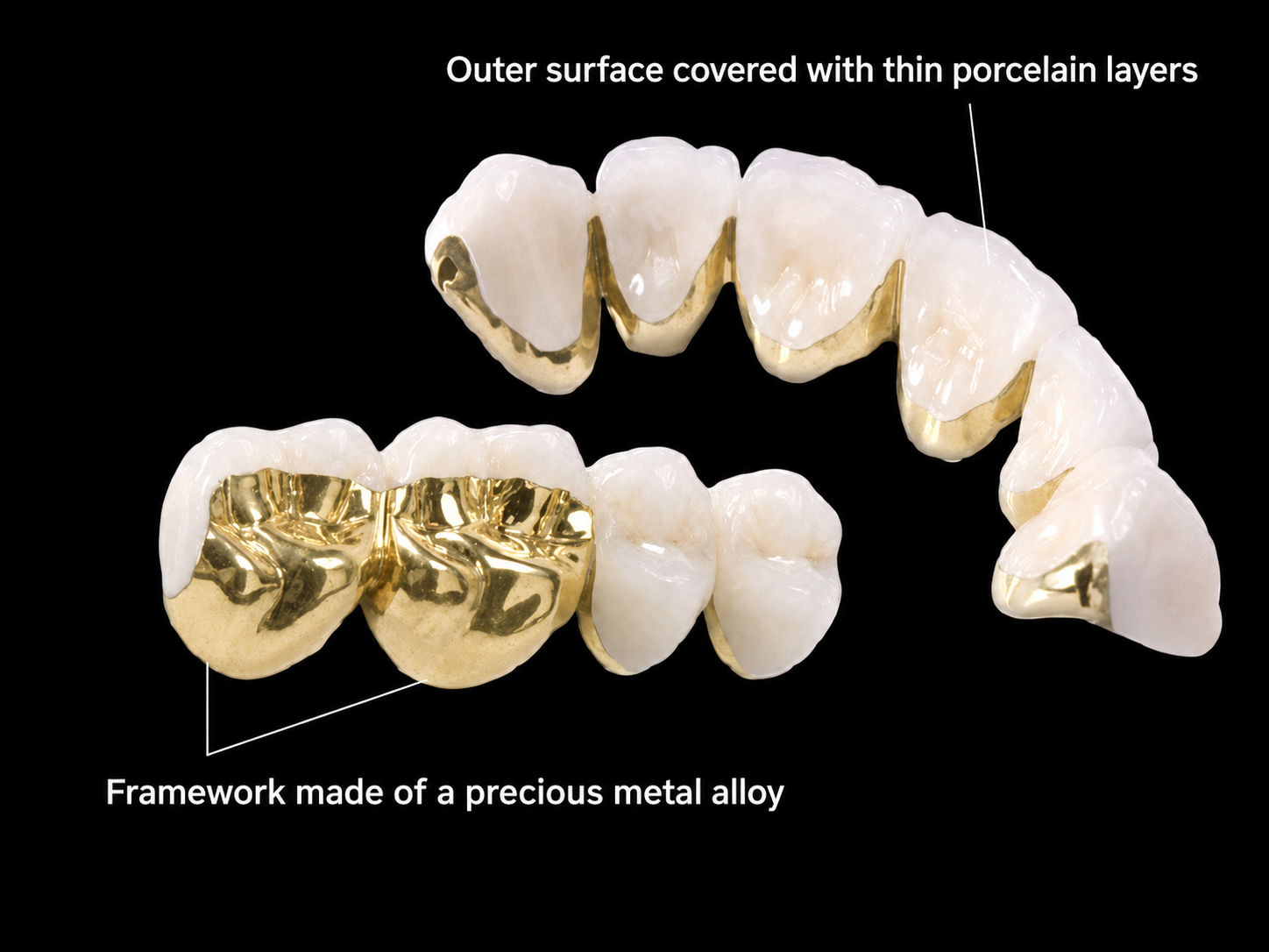 Precious metal-ceramic crowns.