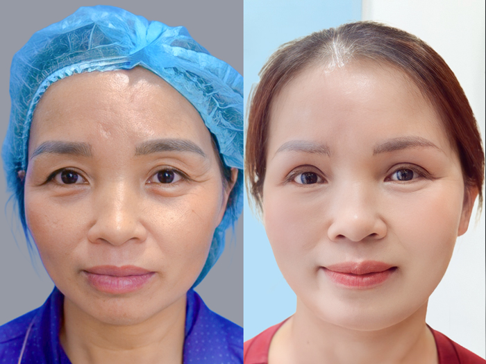 The cost of ptosis and eyelid surgery varies depending on the patient’s condition and selected technique.