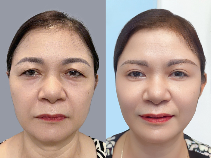 Revision surgery may be considered when recurrent skin laxity or a previous eyelid problem becomes significant.